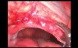Reparación laparoscópica con malla de hernia diafragmática izquierda en un paciente con vólvulo gástrico