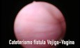 Fístula vésico vaginal. Fistulorrafia laparoscópica. Laparoscopic correction vesico vaginal fistula.