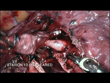 Lobectomía inferior derecha asistida por robot del pulmón