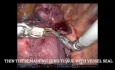 Segmentectomía pulmonar compleja - S9+10 izquierda 