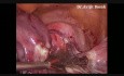 Histerectomía laparoscópica total de fibroma cervical con salpingooforectomía bilateral 