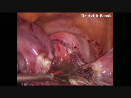 Histerectomía laparoscópica total de fibroma cervical con salpingooforectomía bilateral 