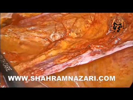 Reparación laparoscópica de una hernia directa omitida