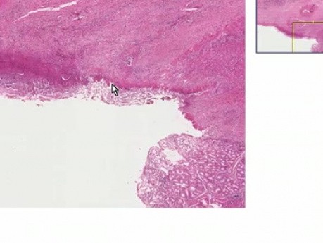 Úlcera duodenal crónica penetrante - histopatología - intestino delgado