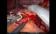 SSAT 2023 - Esofagectomía transhiatal robótica