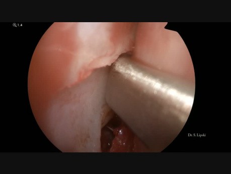 Septoplastia endoscópica y resección de algunos pólipos