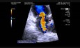Papel de las cuerdas tendinosas en la insuficiencia mitral