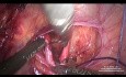 Disección anterior y ligadura de la arteria uterina en su origen en un útero grande
