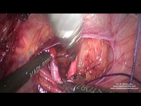 Disección anterior y ligadura de la arteria uterina en su origen en un útero grande