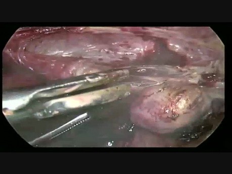 Histerectomía total laparoscópica con resección bilateral de los anexos  