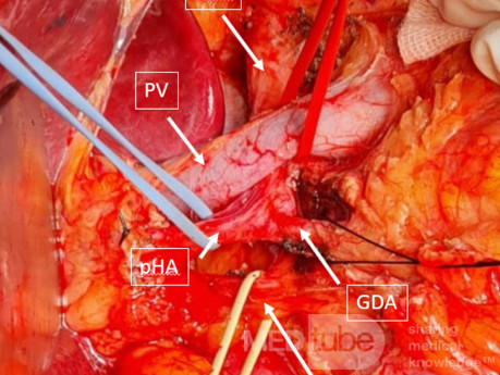 Arteria hepática detrás de la vena porta