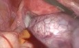 Cistectomía paratubárica laparoscópica con torsión ovárica