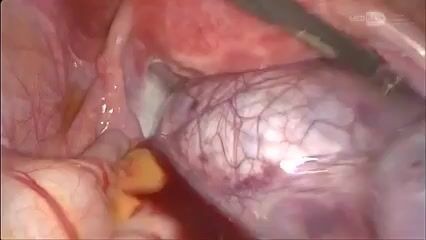 Cistectomía paratubárica laparoscópica con torsión ovárica