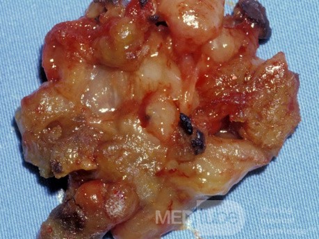 Sinusitis alérgica micótica [contenido de los senos maxilares]