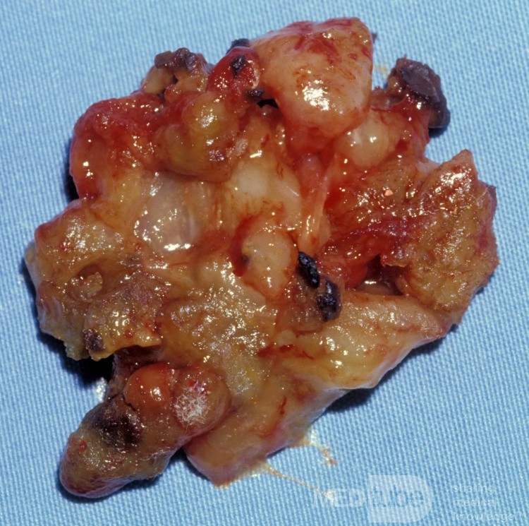 Sinusitis alérgica micótica [contenido de los senos maxilares]