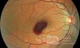 Hemorragia prerretiniana en paciente de 38 años durante estornudos