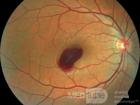 Hemorragia prerretiniana en paciente de 38 años durante estornudos