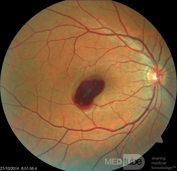 Hemorragia prerretiniana en paciente de 38 años durante estornudos