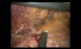 Gastrectomía total laparoscópica + linfadenectomía D2 en paciente obeso (video completo)
