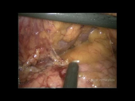 Gastrectomía total laparoscópica + linfadenectomía D2 en paciente obeso (video completo)