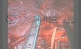 Uniportal VATS Middle Lobectomy Lung Cancer