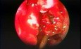 Dehiscencia del hueso lagrimal - endoscopia