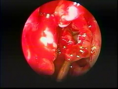 Dehiscencia del hueso lagrimal - endoscopia