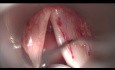 Sulcus Vocalis Tipo 2 (Vergeture)