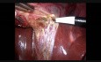 Colecistectomía laparoscópica + Reparación de hernia umbilical + Esterilización tubárica