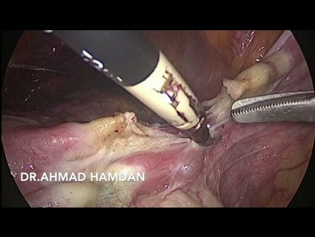Histerectomía laparoscópica total      