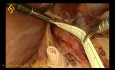 Fundoplicatura laparoscópica de Heller y Dor