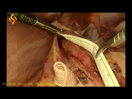 Fundoplicatura laparoscópica de Heller y Dor