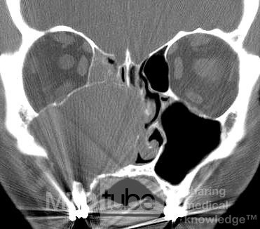 Mucocele gigante del seno maxilar [tomografía computarizada - vista coronal]