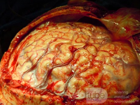Imagen del cerebro durante la cirugía