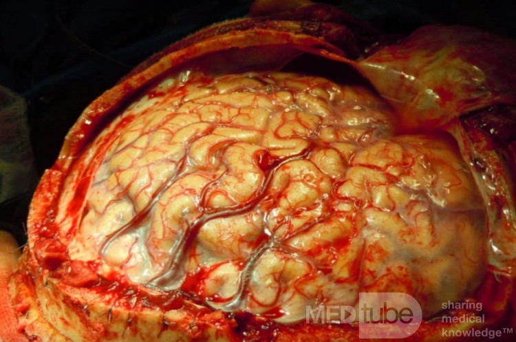 Imagen del cerebro durante la cirugía