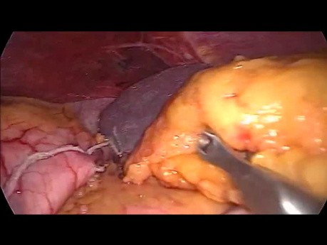 Gastrectomía en manga laparoscópica - primer abordaje del estómago