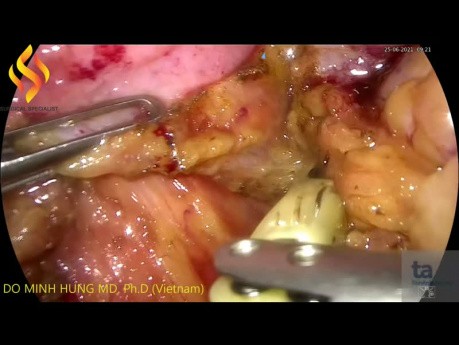 Resección anterior laparoscópica para el cáncer de colon rectosigmoide