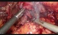 Gastrectomía total D2 laparoscópica