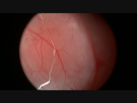 Eritrocitos Vistos Con Endoscopio