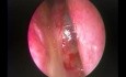 Quiste de colesterol septal nasal posterior - extracción endoscópica