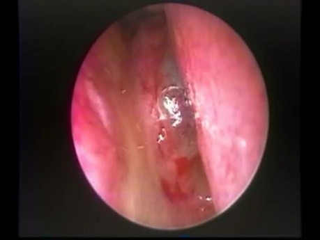 Quiste de colesterol septal nasal posterior - extracción endoscópica