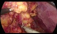 Gastrectomía totalmente laparoscópica en un paciente obeso con cáncer gástrico