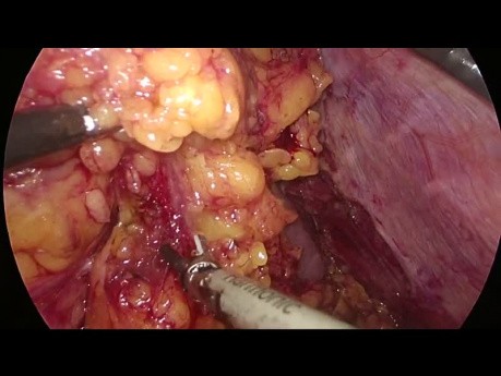 Gastrectomía totalmente laparoscópica en un paciente obeso con cáncer gástrico