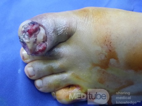 Uña encarnada del dedo gordo del pie con hallux valgus