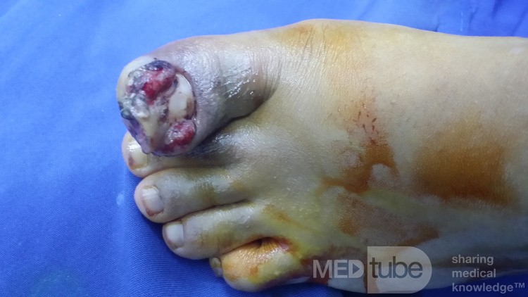 Uña encarnada del dedo gordo del pie con hallux valgus