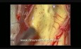 Tumor de médula espinal - Intramedular cervical - Extirpación microquirúrgica