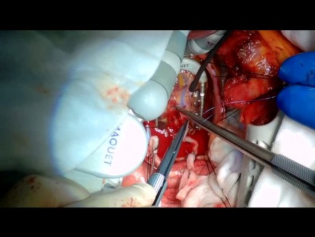 Repetición de la cirugía de bypass coronario sin bomba mediante toracotomía izquierda