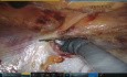 Hernia incisional robótica de queso suizo Rives-Stoppa, doble acoplamiento, doble TAR, doble malla central