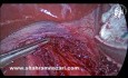 Tratamiento de la acalasia: miotomía laparoscópica de Heller y fonduplicatura de Dor