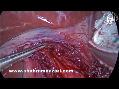 Tratamiento de la acalasia: miotomía laparoscópica de Heller y fonduplicatura de Dor